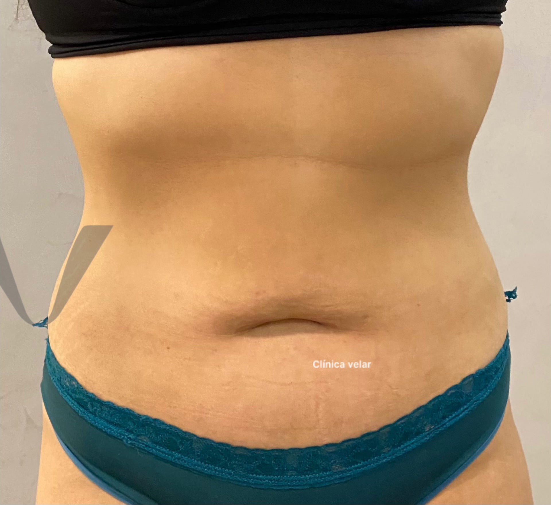 Tratamento de Estética Corporal na Clínica Velar