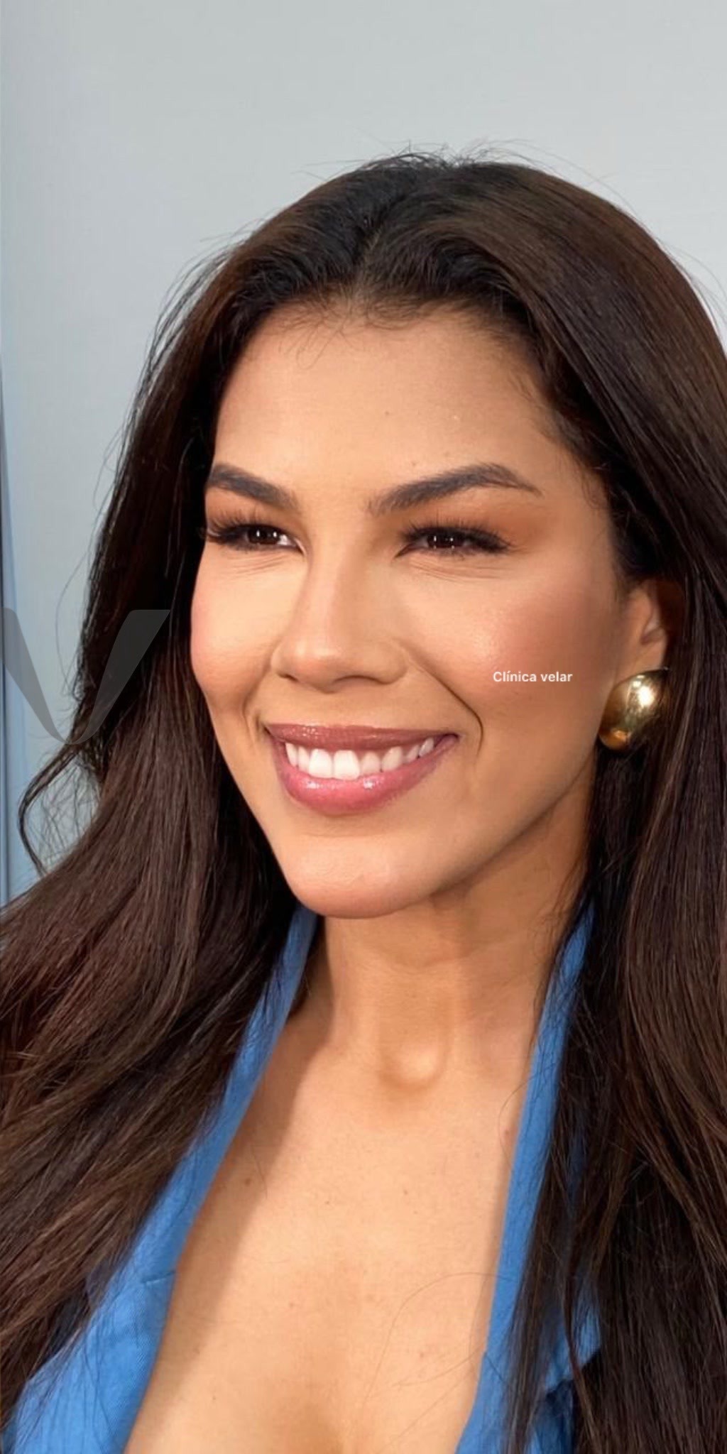 Tratamento de Harmonização Facial na Clínica Velar