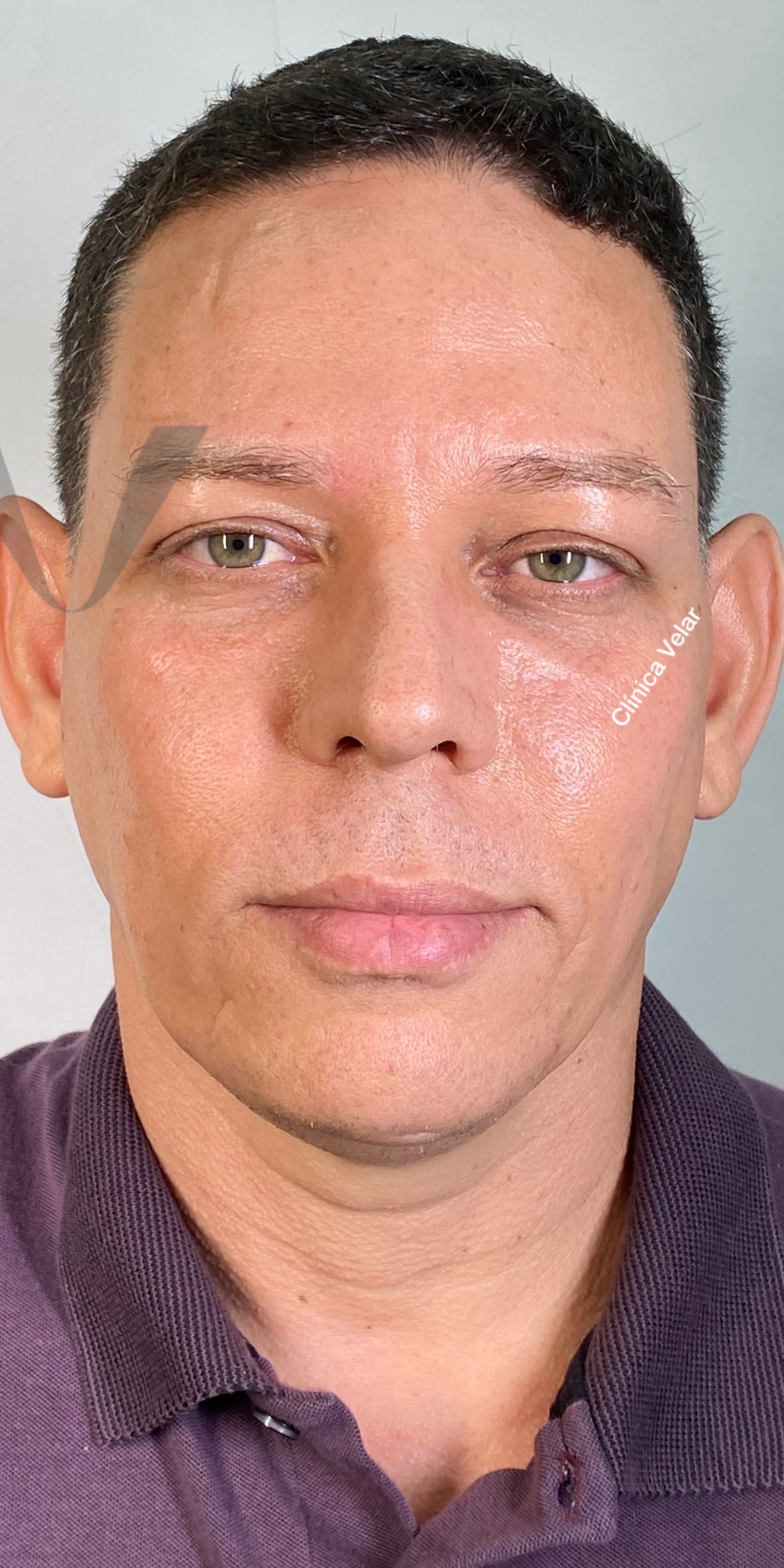 Tratamento de Harmonização Masculina na Clínica Velar
