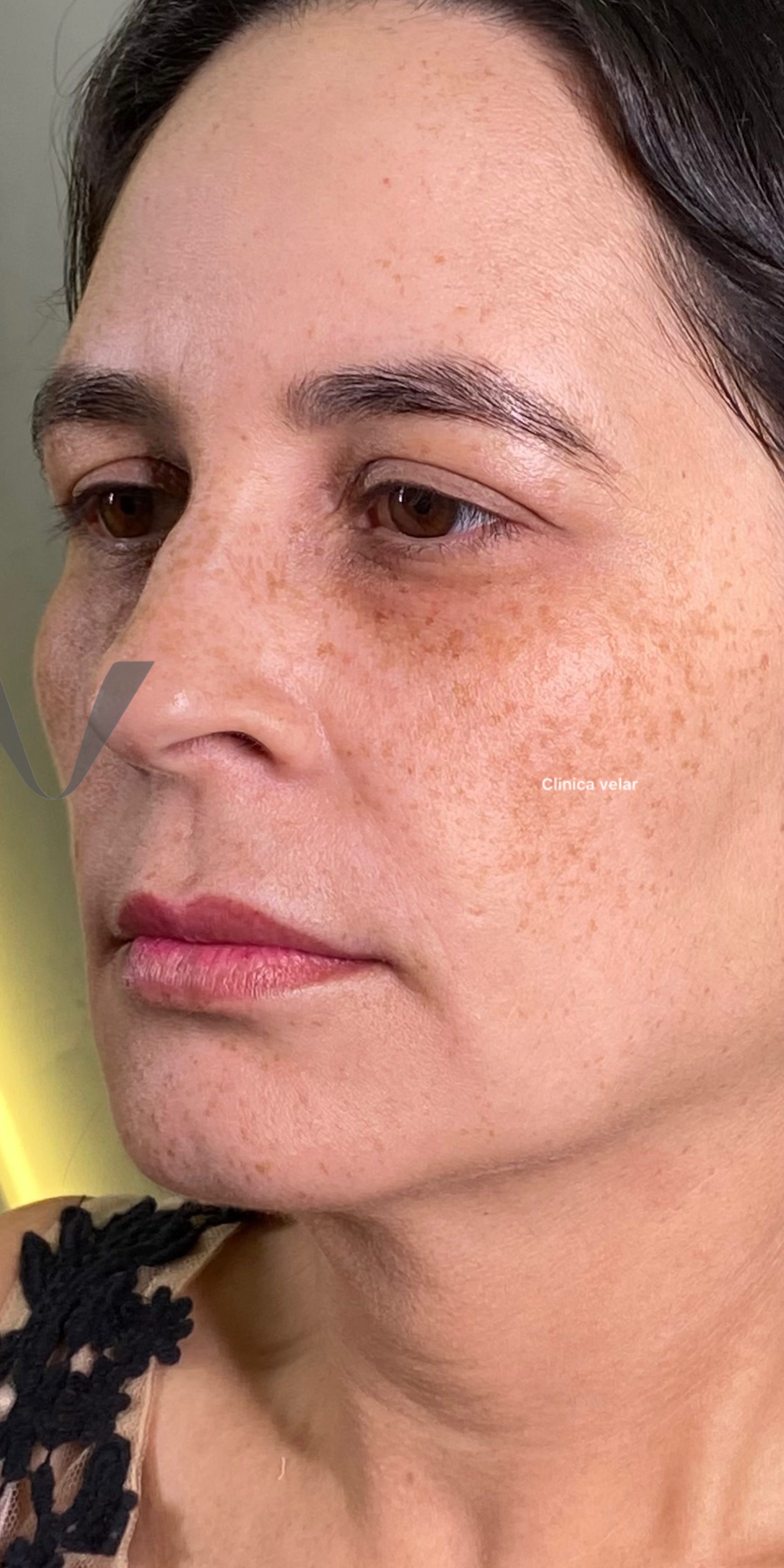 Tratamento de Melasma na Clínica Velar