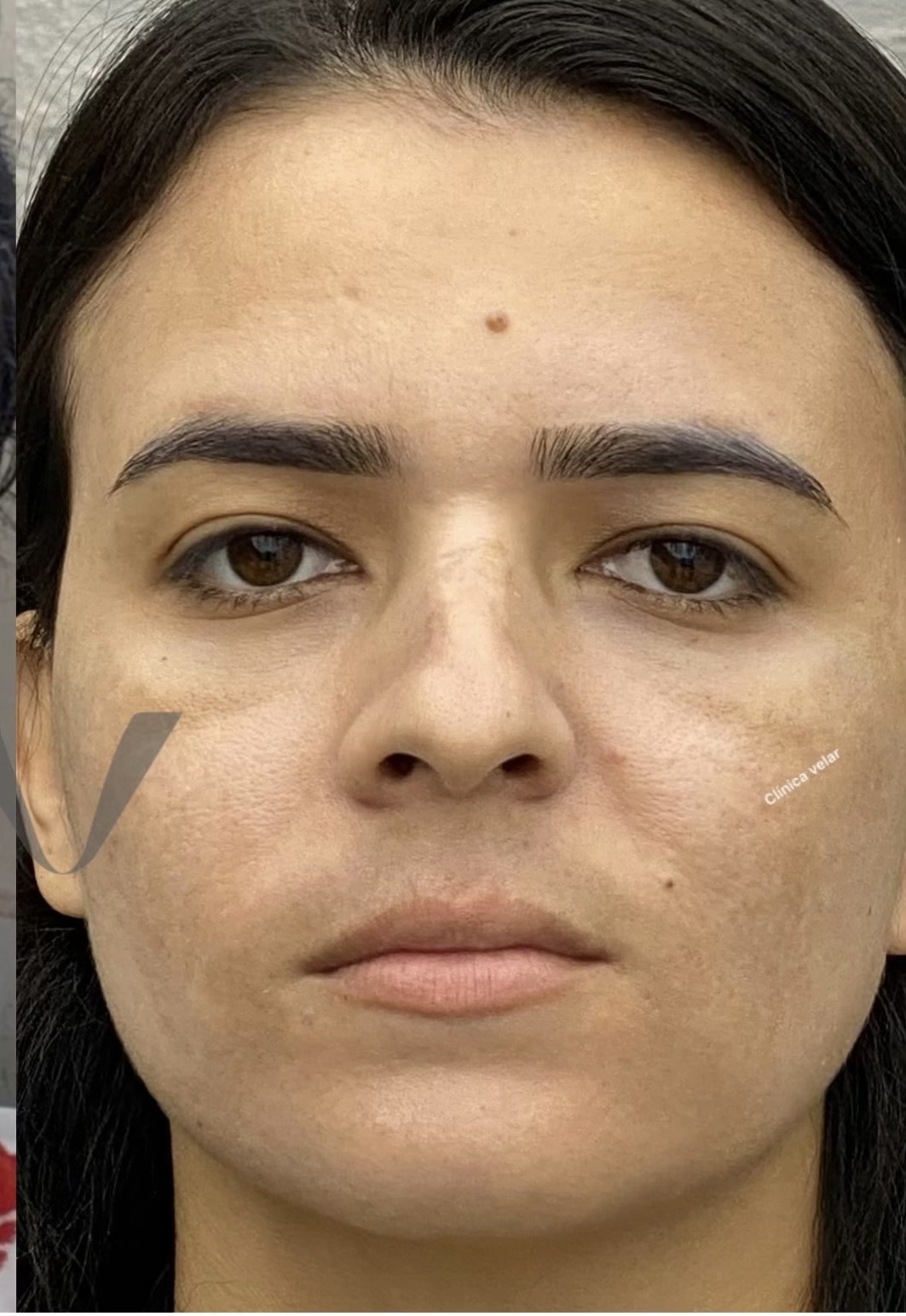 Limpeza de pele e Skincare na Clínica Velar