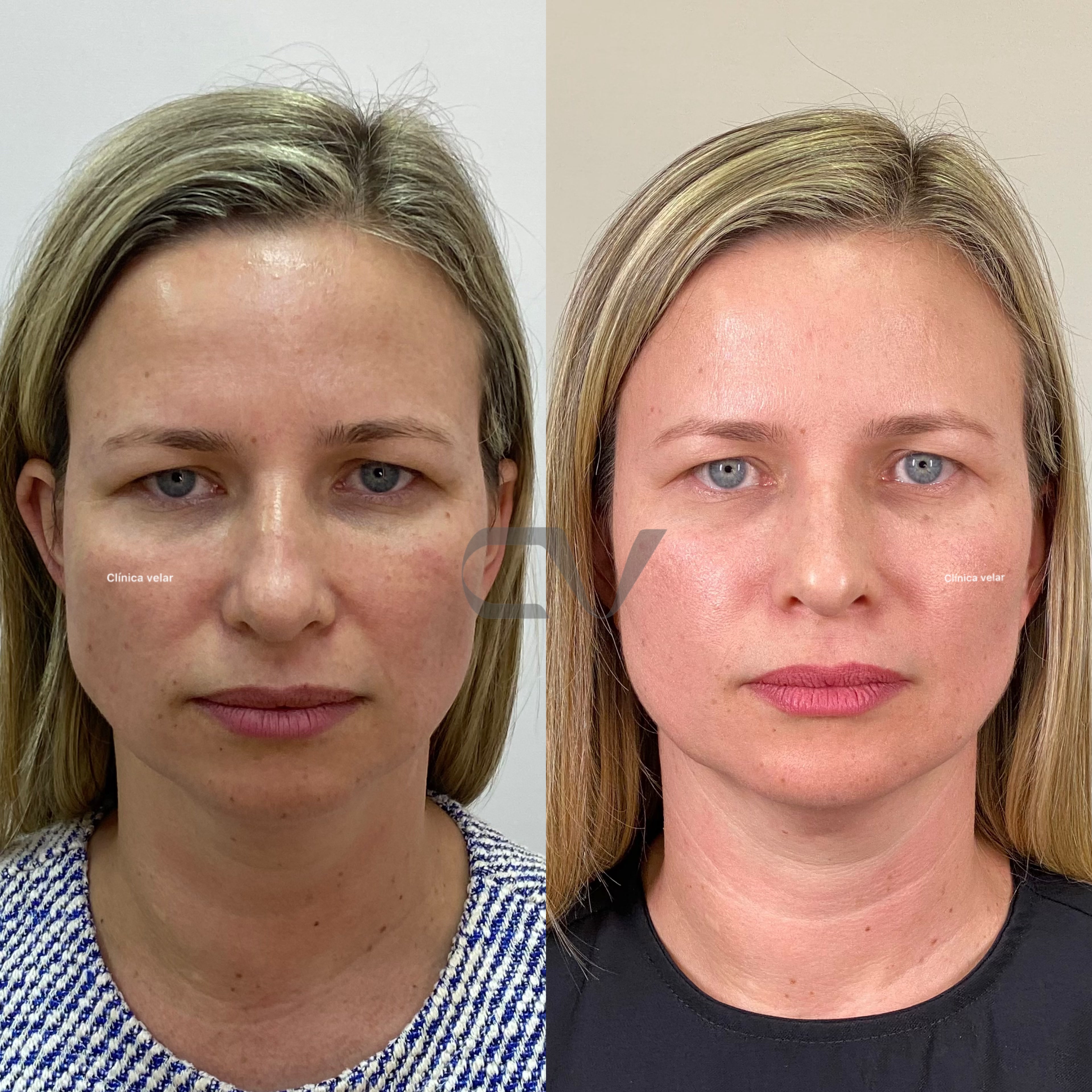 Face Lift - Caso Real 1