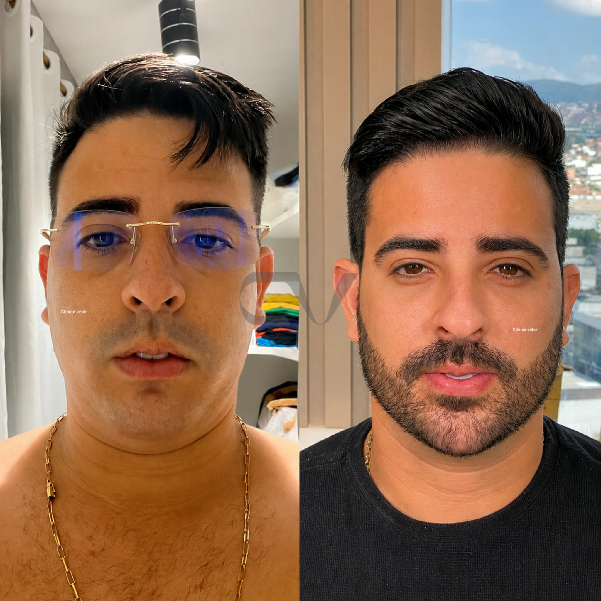 Harmonização Facial - Caso Real 1