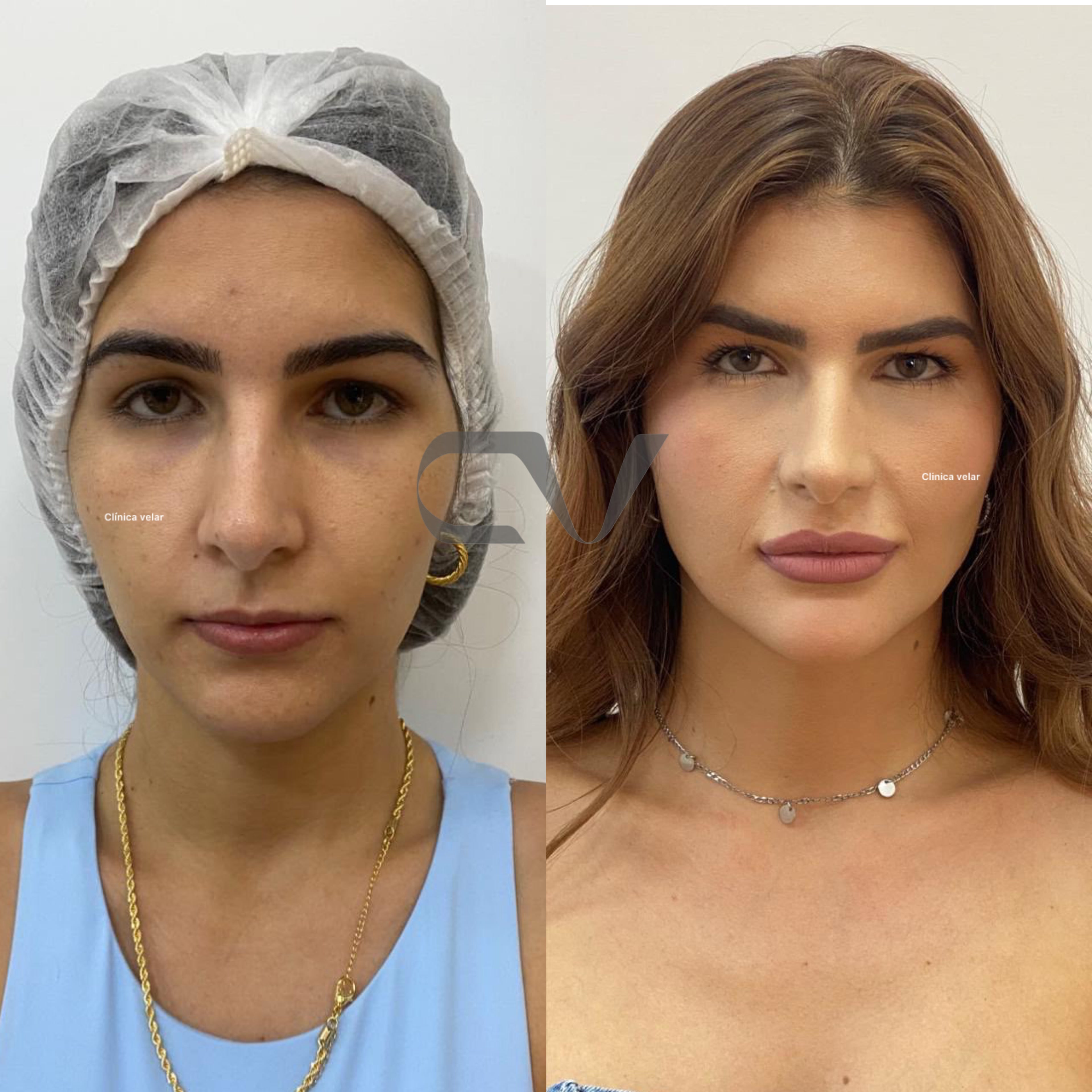 Harmonização Facial - Caso Real 1