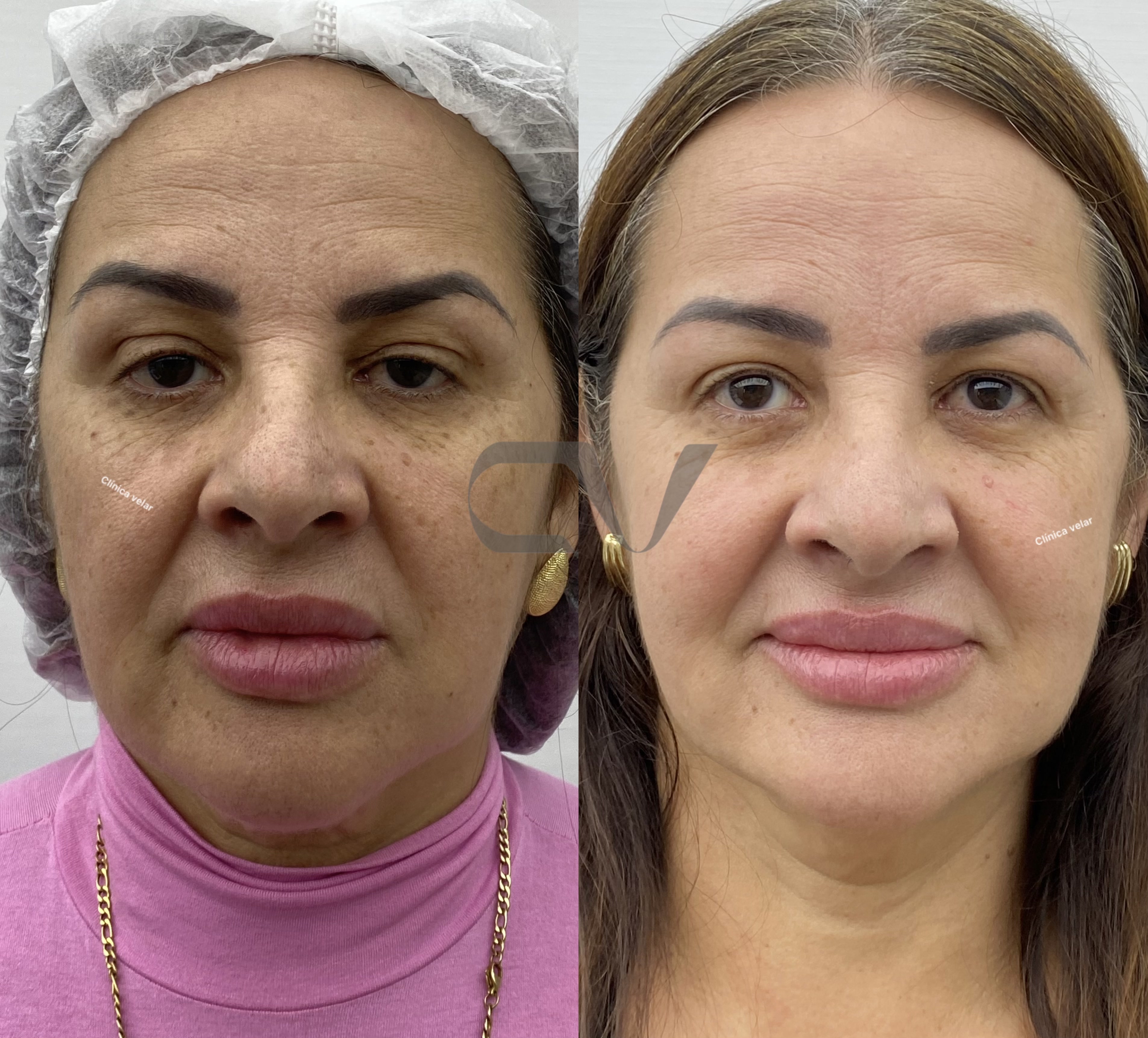 Revita Glow - Caso Real 2