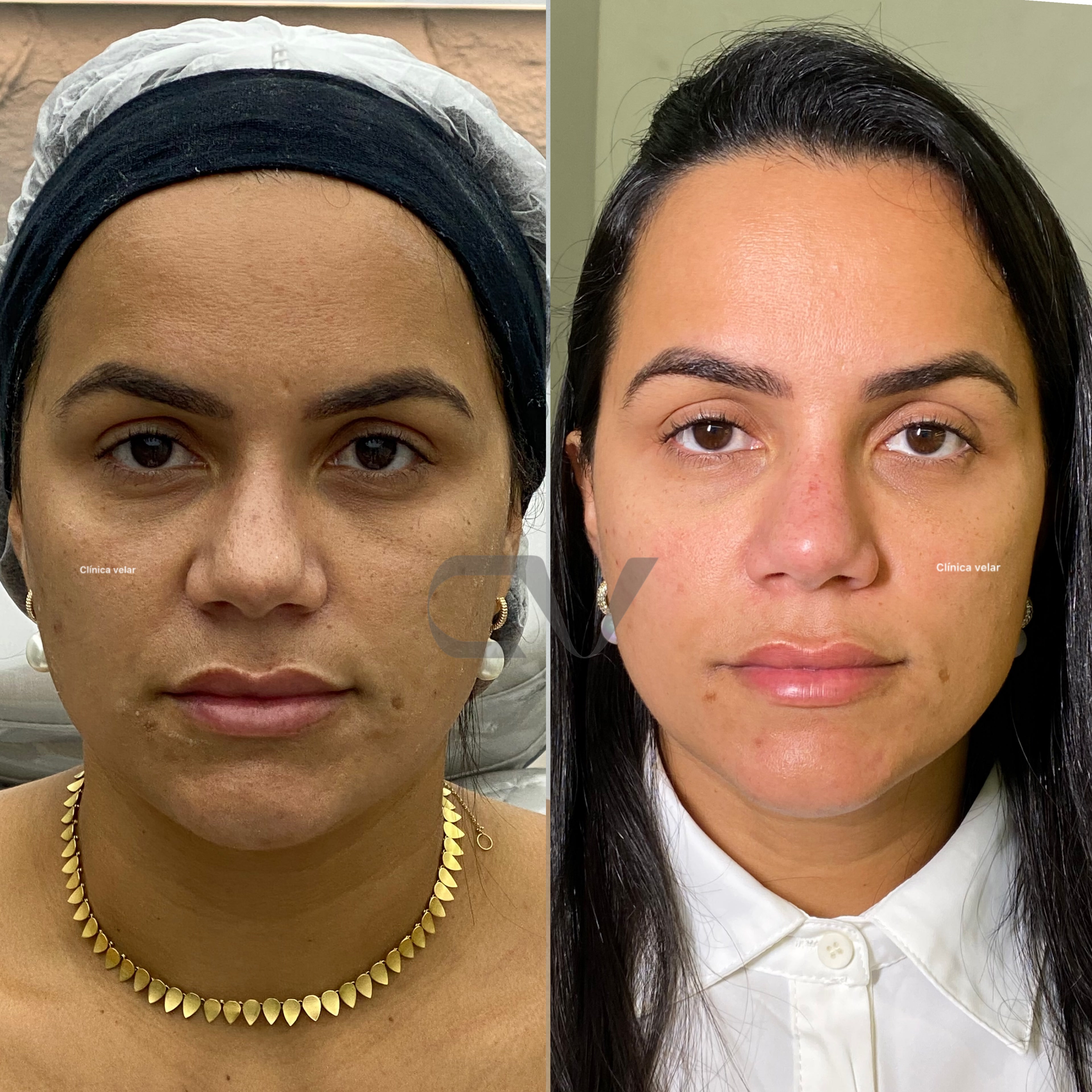 Evolução Melasma - Caso Real 2