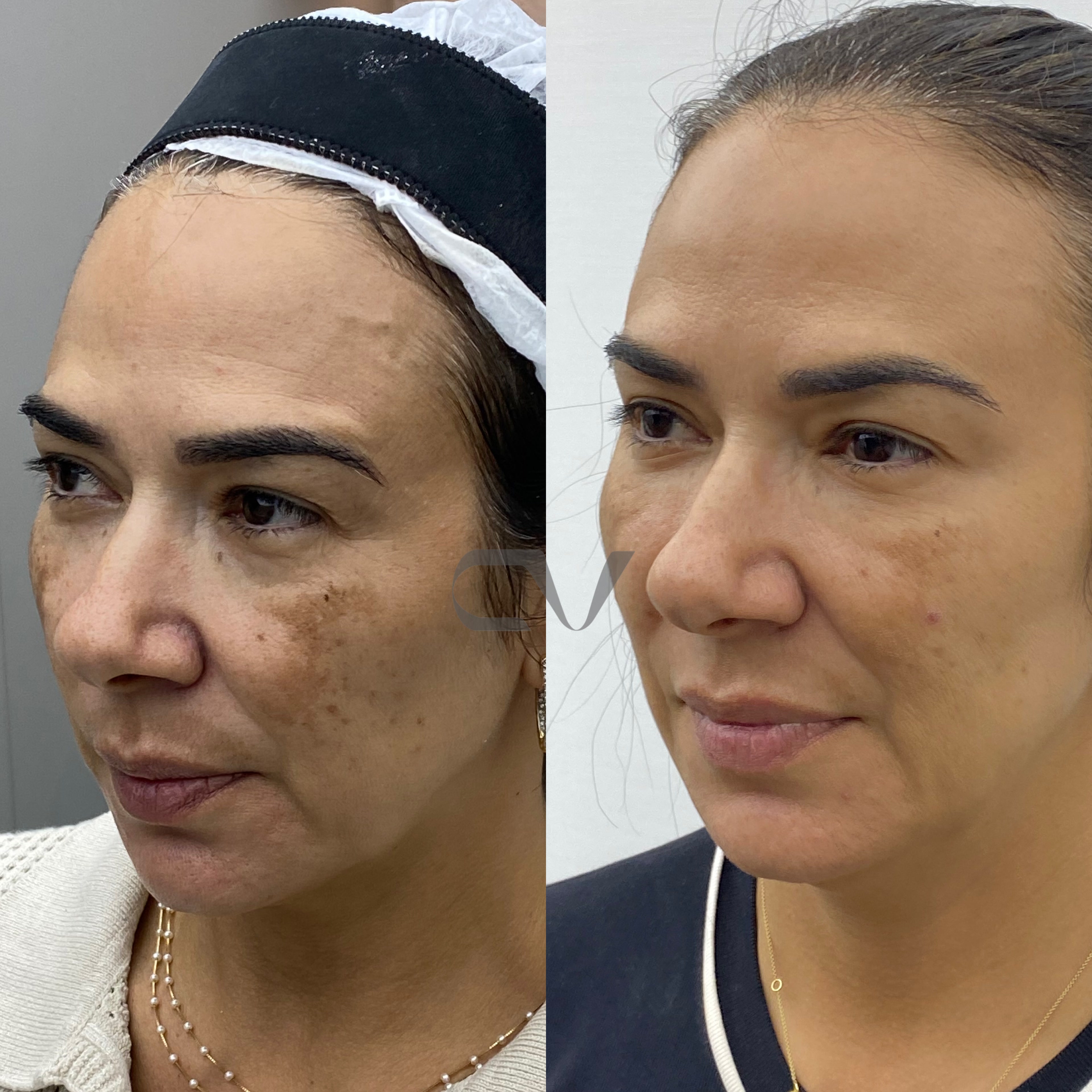 Evolução Melasma e Tom de Pele - Caso Real 1